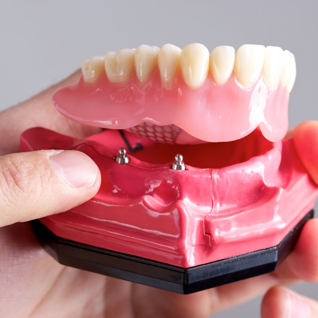 imagem de dentadura a ser preparada para implante dentário all on four