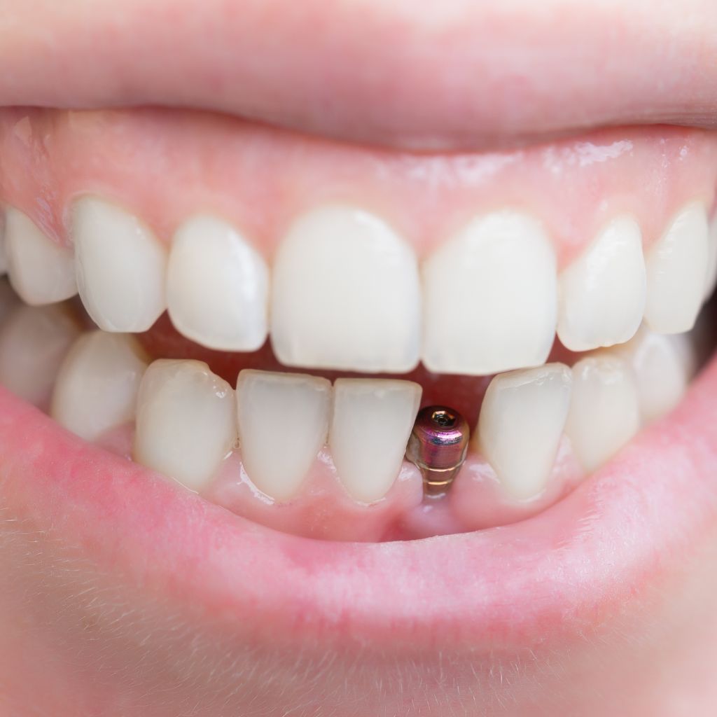 imagem de sorriso com falta de um dente a ser preparado para implante